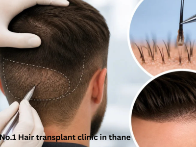 Advanced No.1 Hair Transplant Clinic in Thane – DNA Royal.