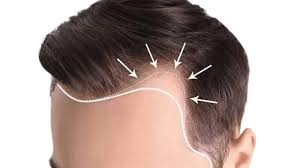 The Future of Hair Restoration Is Here — GFC Treatment in Delhi!