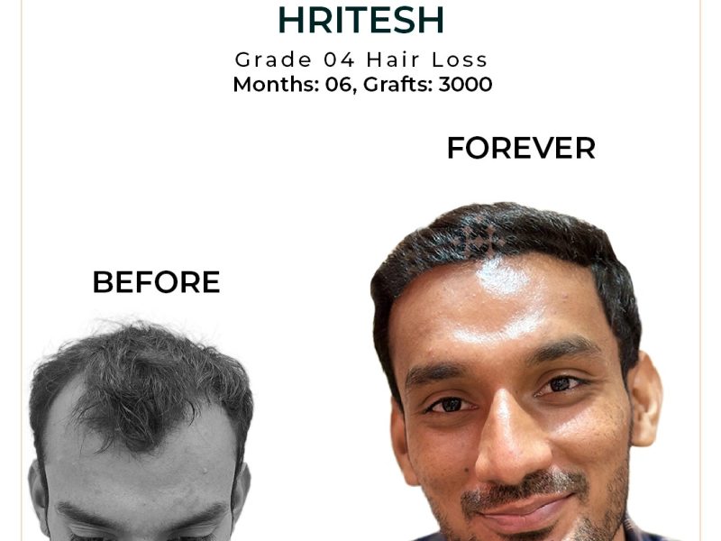 Redefine Your Look — Hairline Reconstruction Done to Perfection!
