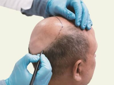 Trust Us for the Best Hair Transplant in Melbourne for Natural Results
