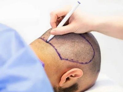Best PRP Therapy in Delhi — Harness Your Body's Own Power to Regrow Hair