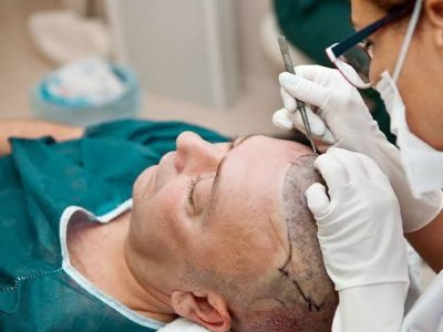 No Shave, No Stress — Get Your Hair Transplant Without Anyone Knowing