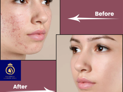 Professional Laser Resurfacing Treatment in Thane – DNA Royal Experts.