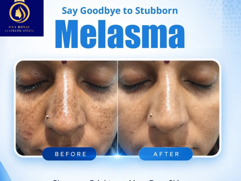 Transform Your Skin with the Best Melasma Treatment in Thane | DNA Royal.
